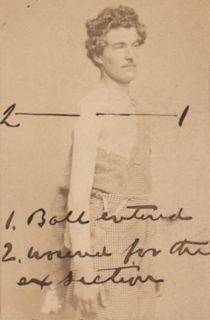 Wounded soldier with diagram of path of the bullet, ca. 1861. (GLC05111.02.1293)